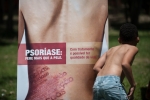 Dermatologia psoriase doenca de pele 0316